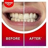 COLGATE Max White Ultimate at Home LED Teeth whitening kit | Enamel Safe | Reverses up to 20 Years of Stains** | Whitening Pen & Smartphone Powered LED Whitening Light | Developed by Dental Experts