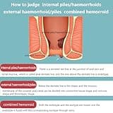 Haemorrhoids & Piles Cream 20g - Hemorrhoids Treatment and Prevention - Helps with for Pain, Swelling, Itching & Bleeding, Maximum Pain Relief