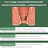Hemorrhoid Cream 20g - Helps Relieve Discomfort and Soothe Itchy Hemorrhoids, Shrinks Hemorrhoids - Maximum Pain